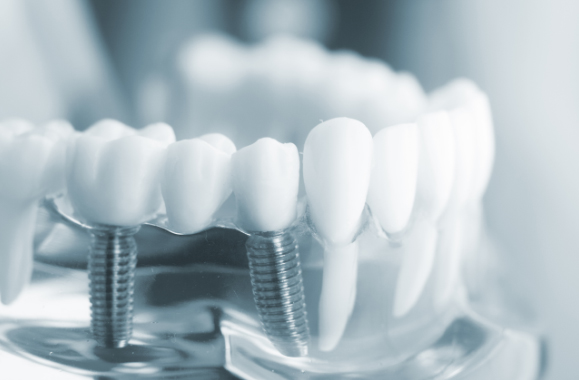 Implante dental